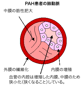 PAH患者の肺動脈